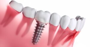 היתרונות של השתלות שיניים לשיקום שיניים חסרות בירושלים